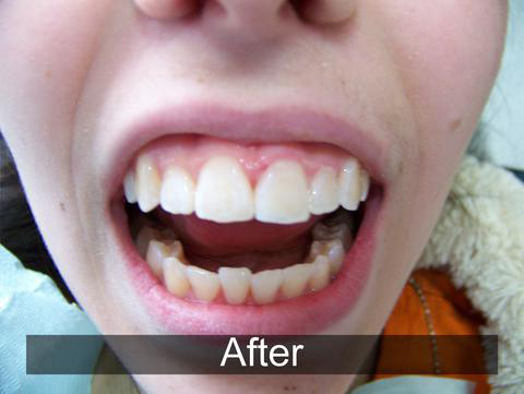 Smiles by Farr | E4D, Veneers and Sleep Apnea