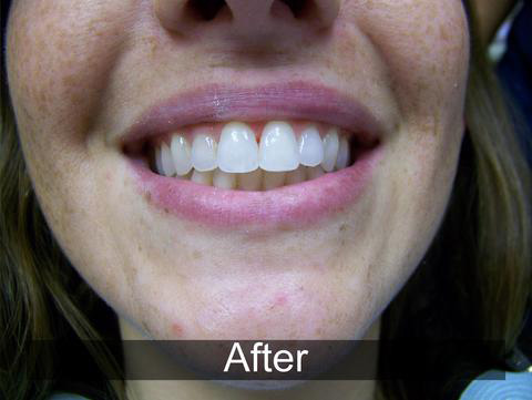 Smiles by Farr | Implant Dentistry, All-on-6 and Invisalign reg 