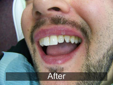 Smiles by Farr | TMJ Disorders, Preventative Program and Veneers