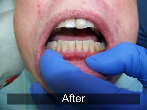 Smiles by Farr | Implant Restorations, Ceramic Crowns and Dental Fillings