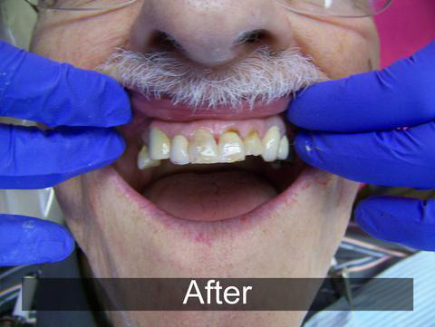 Smiles by Farr | Digital Scanners, Ceramic Crowns and Veneers