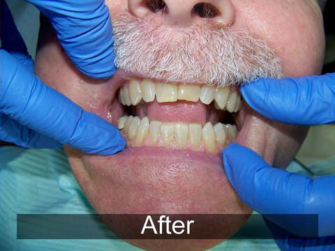 Smiles by Farr | Night Guards, All-on-4® and Dental Cleanings