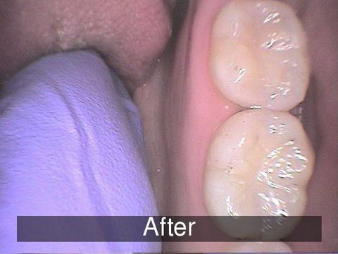 Smiles by Farr | Preventative Program, Root Canals and Dental Cleanings