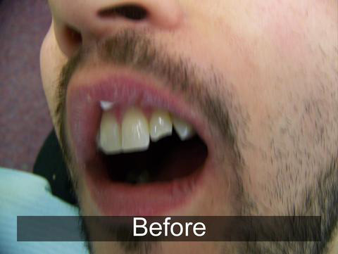 Smiles by Farr | Night Guards, Ceramic Crowns and Preventative Program