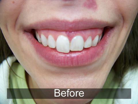 Smiles by Farr | Implant Restorations, Dental Fillings and Digital Impressions