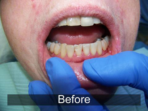 Smiles by Farr | All-on-4 reg , Dental Fillings and Periodontal Treatment