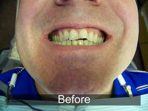 Smiles by Farr | Digital Impressions, Ceramic Crowns and Dental Cleanings