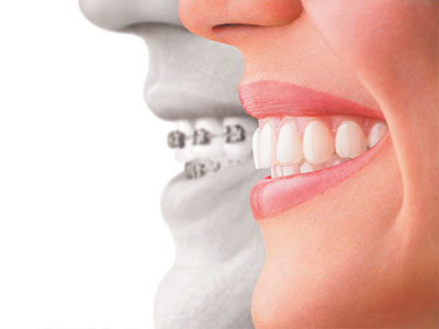 Smiles by Farr | Invisalign reg , E4D and Veneers