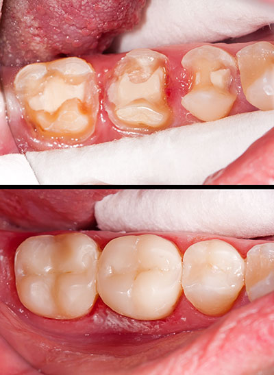 Smiles by Farr | Dentures, TMJ Disorders and Implant Restorations