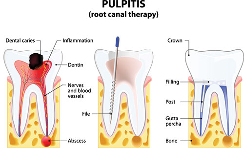 Smiles by Farr | Root Canals, Invisalign reg  and Preventative Program